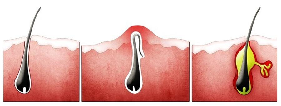 La barba y el pelo encarnado: cómo prevenirlos